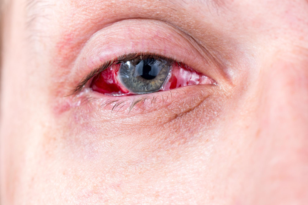 Conjunctivitis