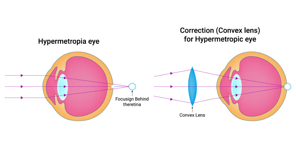 Hyperopia