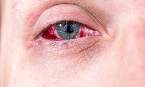 Conjunctivitis