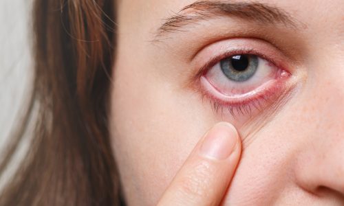 Dry Eye Syndrome