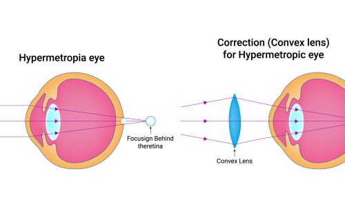 Hyperopia