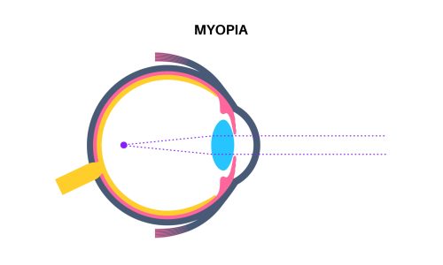 Myopia